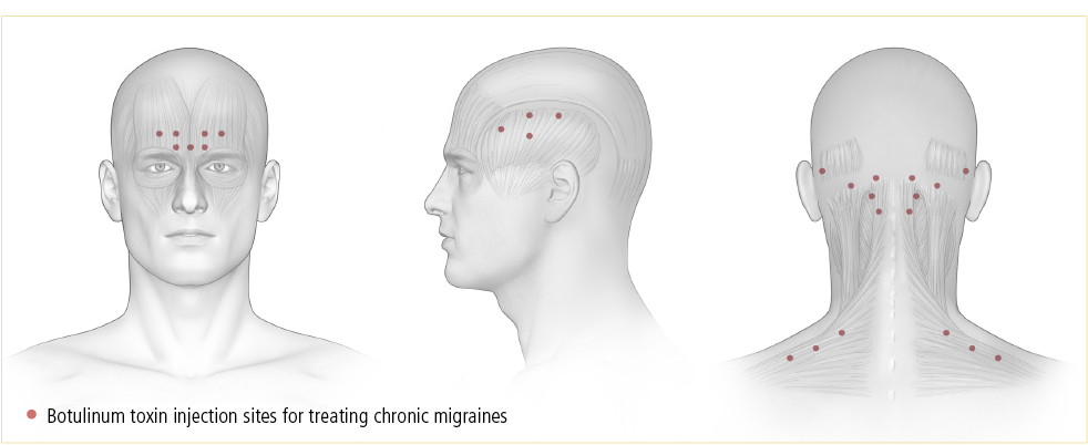 botox for migraine treatment